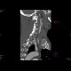 Stenosis of internal carotid artery: CT - Computed tomography